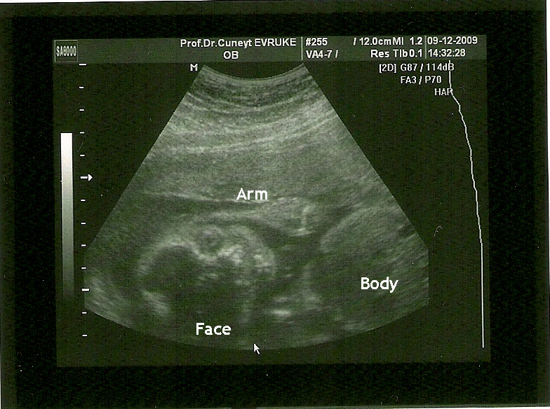 3d ultrasound scan. baby (3D ultrasound scan